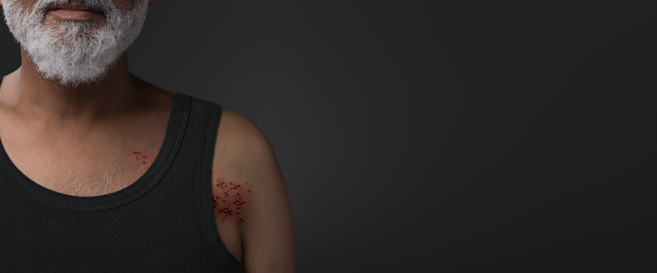 shingles symptoms