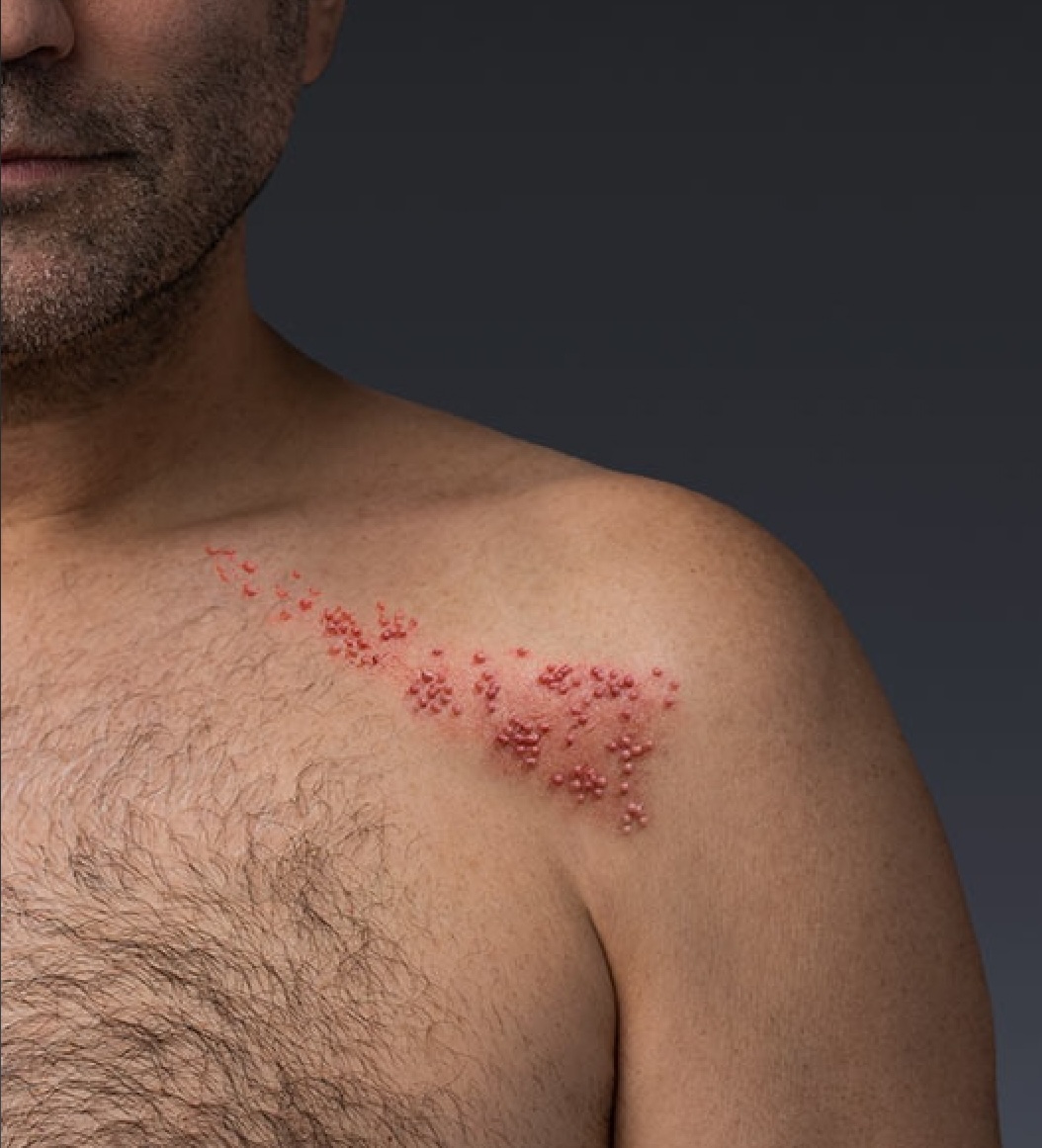 about shingles