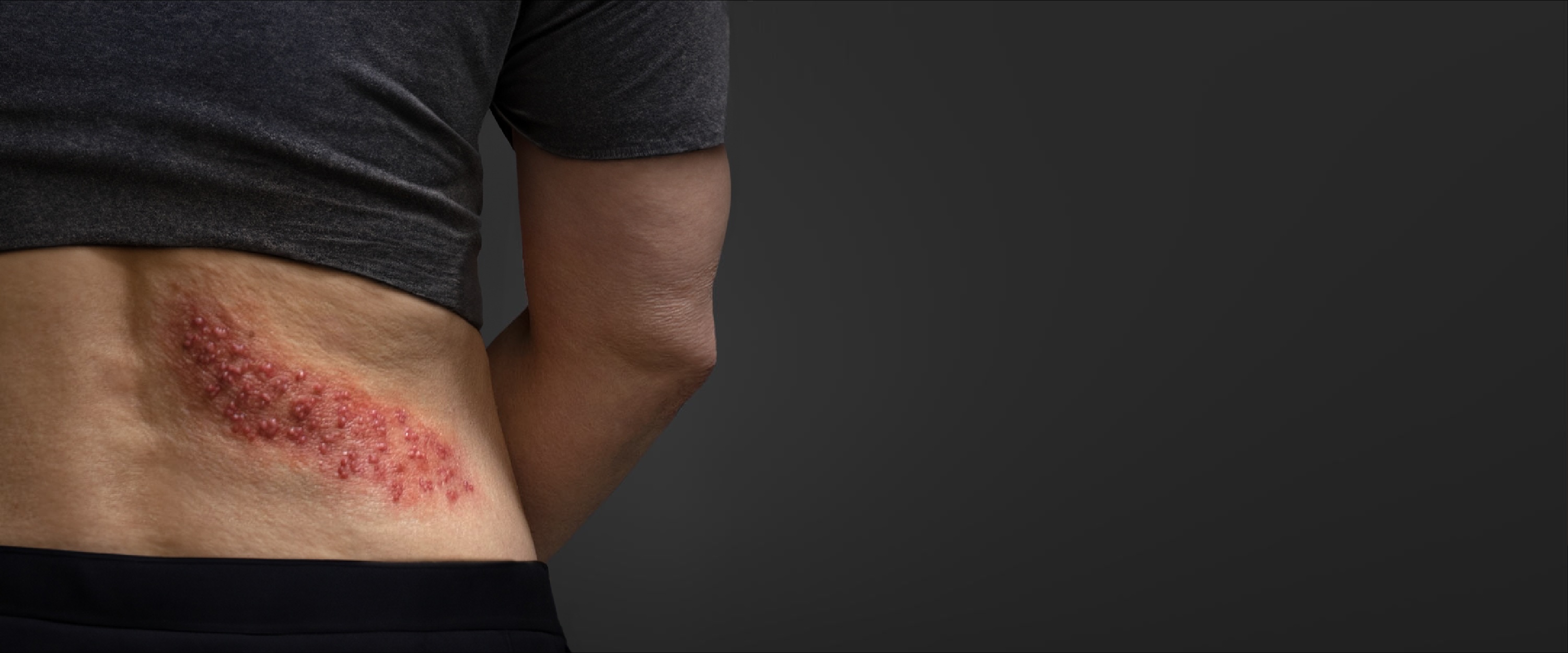 shingles symptoms